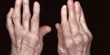 Biến chứng nguy hiểm từ bệnh cơ xương khớp không thể xem thường