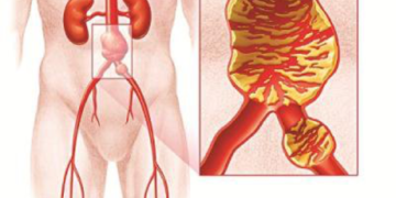 Nguy cơ tử vong từ các bệnh lí mạch máu: sự sống như “ngàn cân treo sợi tóc”