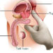 Dấu hiệu cảnh báo sớm bệnh ung thư tuyệt đối không được xem thường