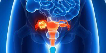 Phòng ngừa ung thư cổ tử cung ở nữ giới